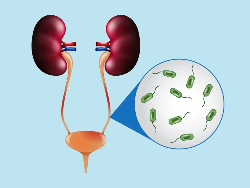Urinary Tract Infection