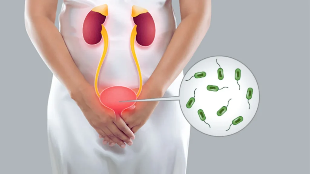 Urinary Tract Infection